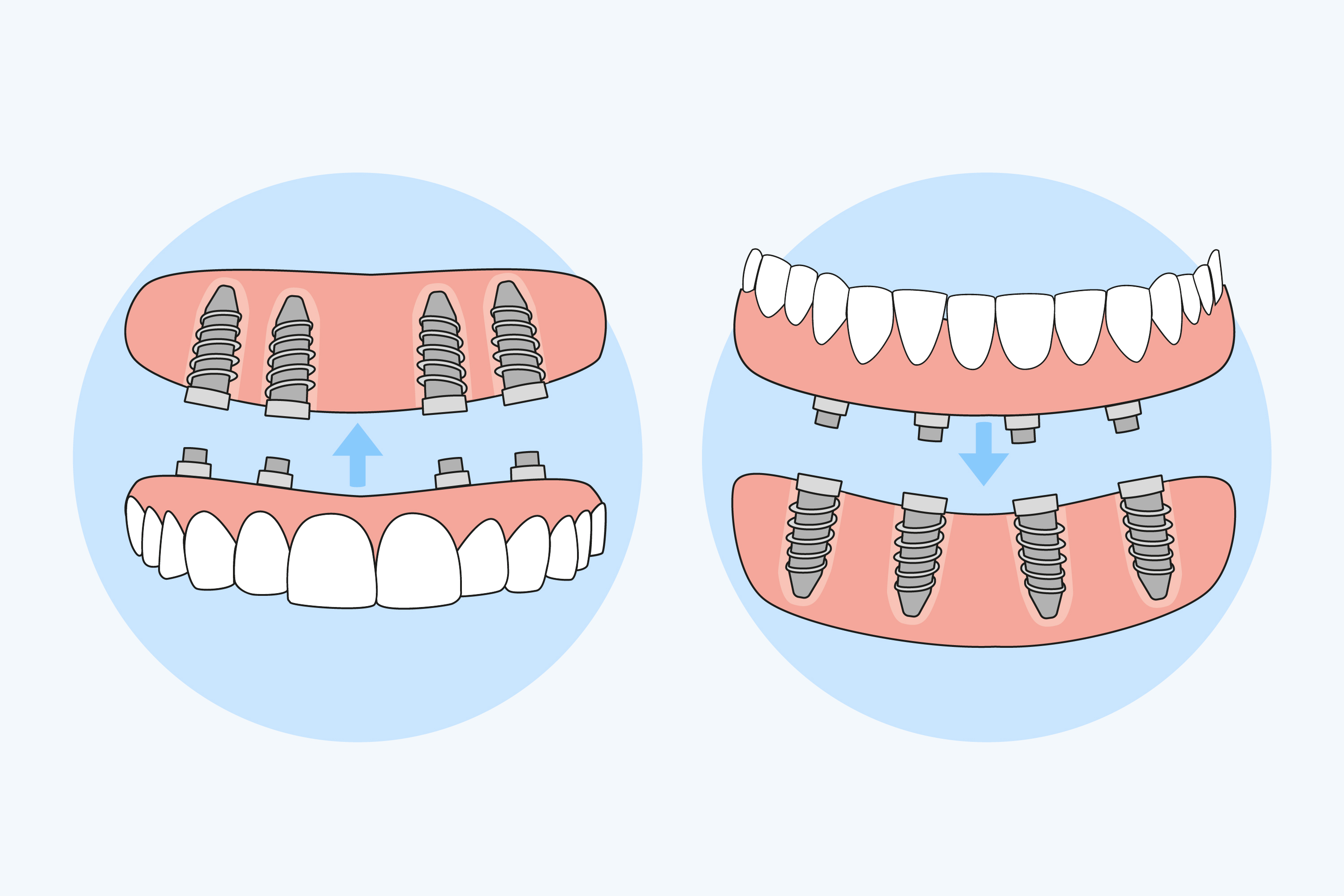 All-on-4 dental implants Midvale, UT 