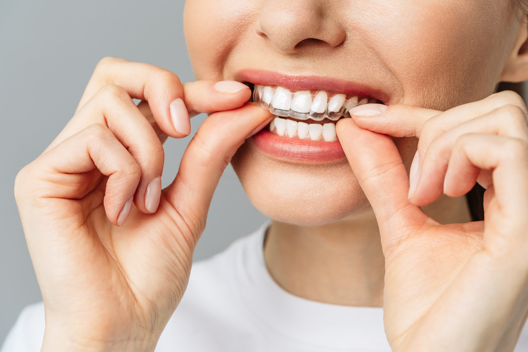 Invisalign dentist Midvale, UT