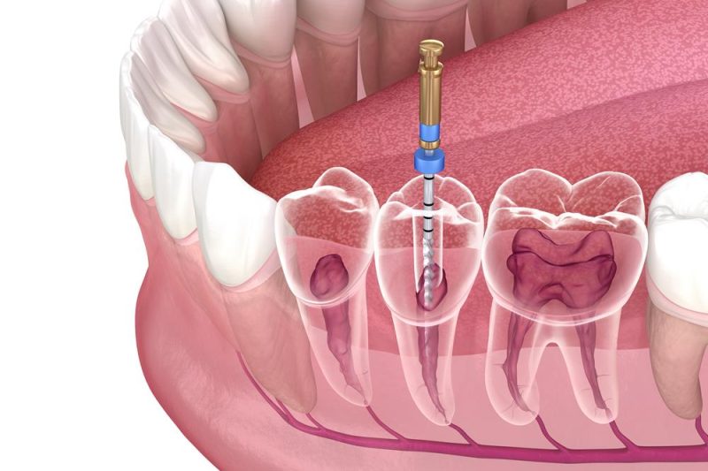 Root Canal Treatment in Midvale - Dental Midvale